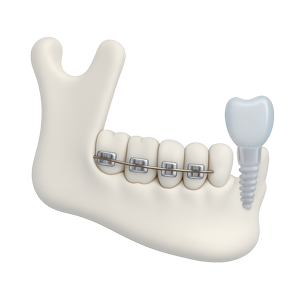 a jaw with teeth, braces and an implant