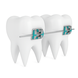 metal braces