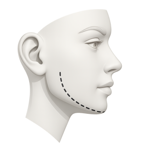 Early Treatment (Phase 1) illustration of jawline